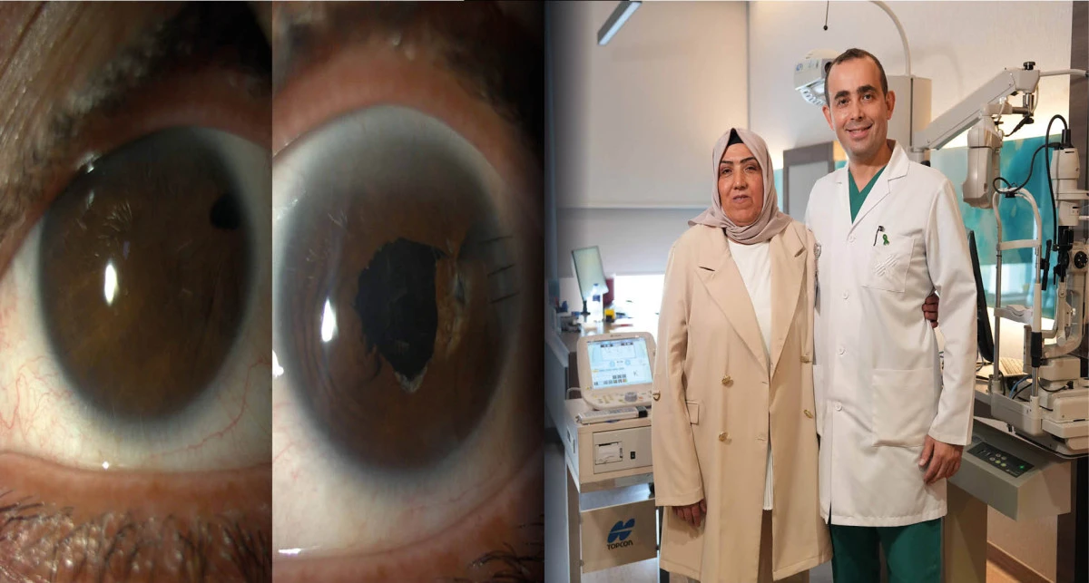 20 yıl sonra net görmeye başladı; 'bana gözümü verdiler'