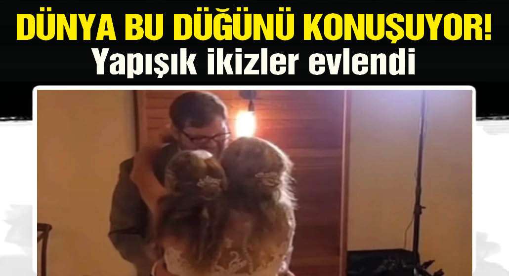 Dünya bu düğünü konuşuyor! Yapışık ikizler evlendi, ikizlerden biri şimdi çocuk istiyor