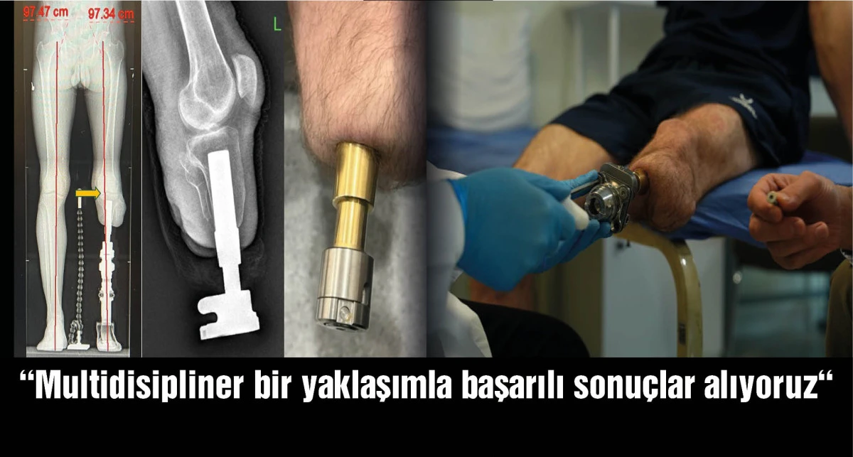 Prof. Dr. Adnan Kara: Osseoıntegrasyon sayesinde doğal yürüyüş mümkün